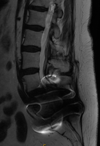 MRI for Case 2 demonstrating hardware artifact that complicates lumbar assessment