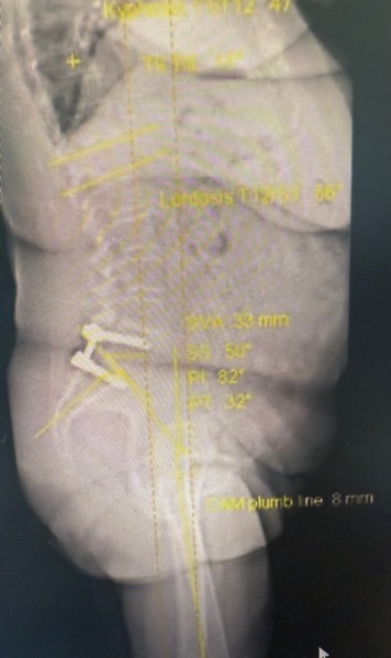 Case 2 standing radiograph showing prior lumbar fusion and spinopelvic alignment