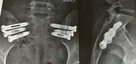 Post-treatment imaging for Case 4 showing sacroiliac fixation